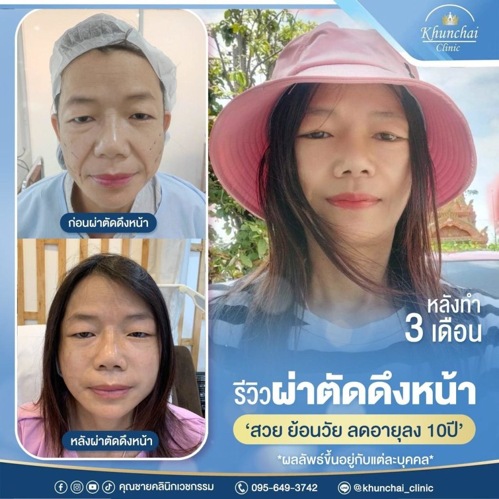 LINE_ALBUM_ดึงหน้า_250917_10