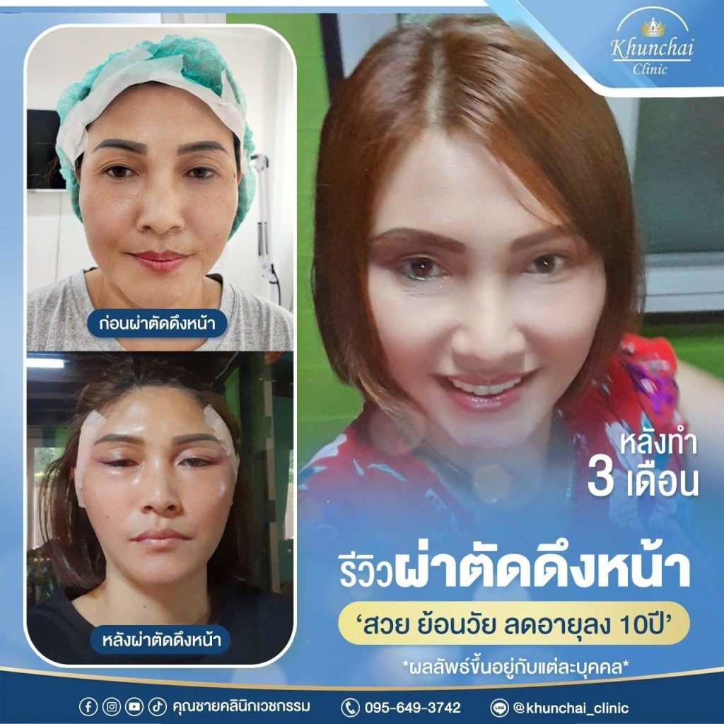 LINE_ALBUM_ดึงหน้า_250917_11