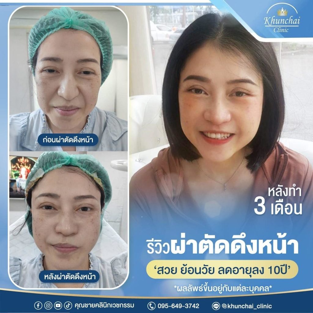 LINE_ALBUM_ดึงหน้า_250917_6