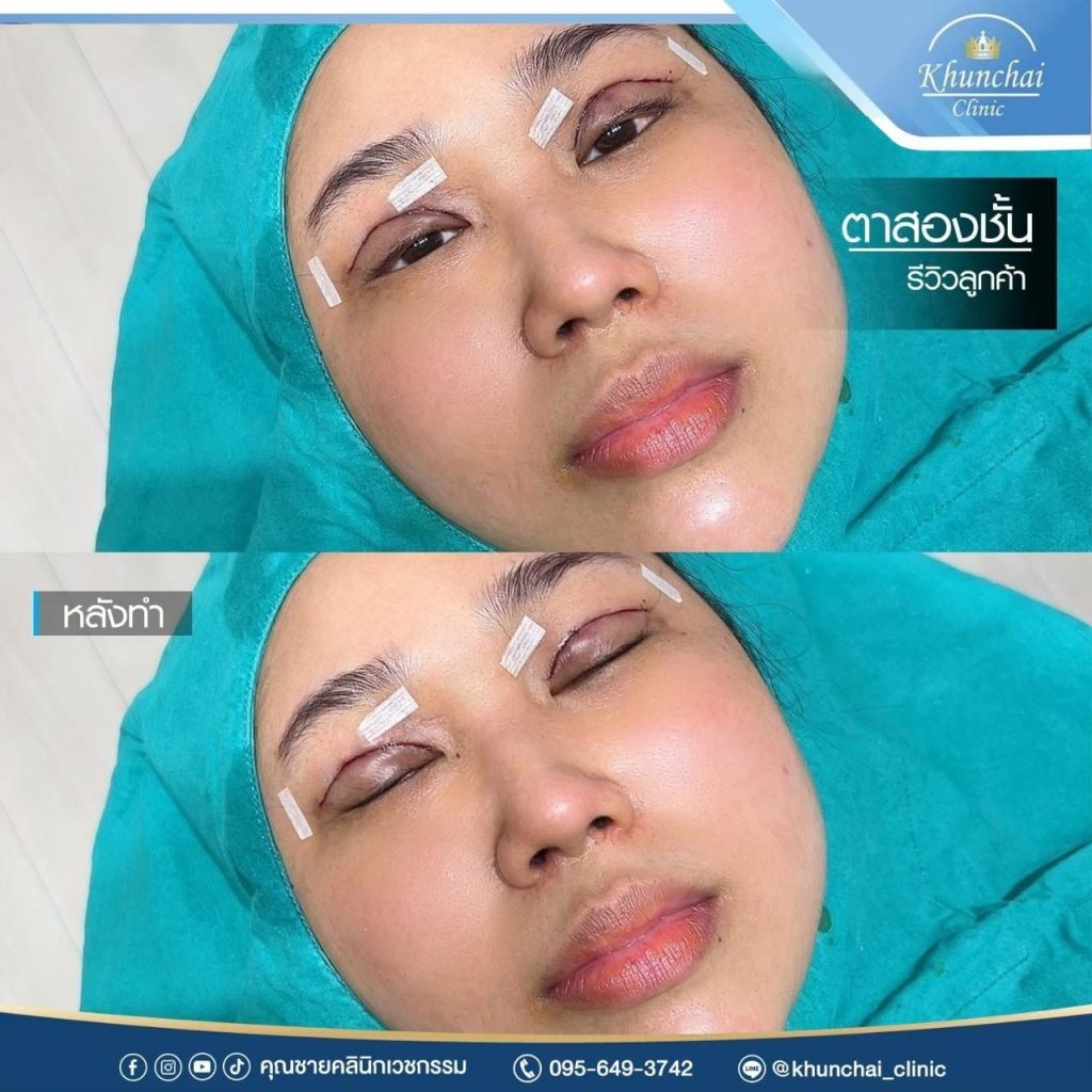 ตาสองชั้น