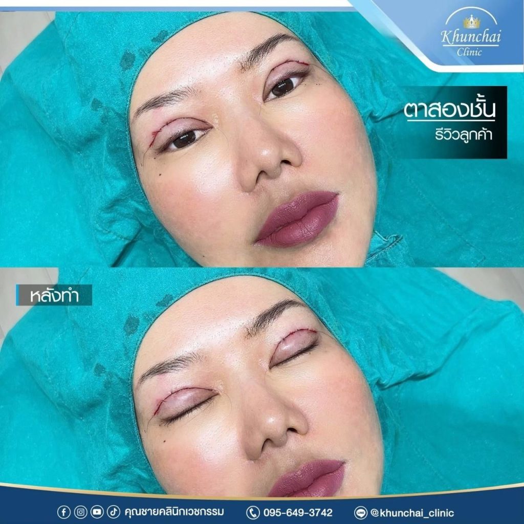 ตาสองชั้น