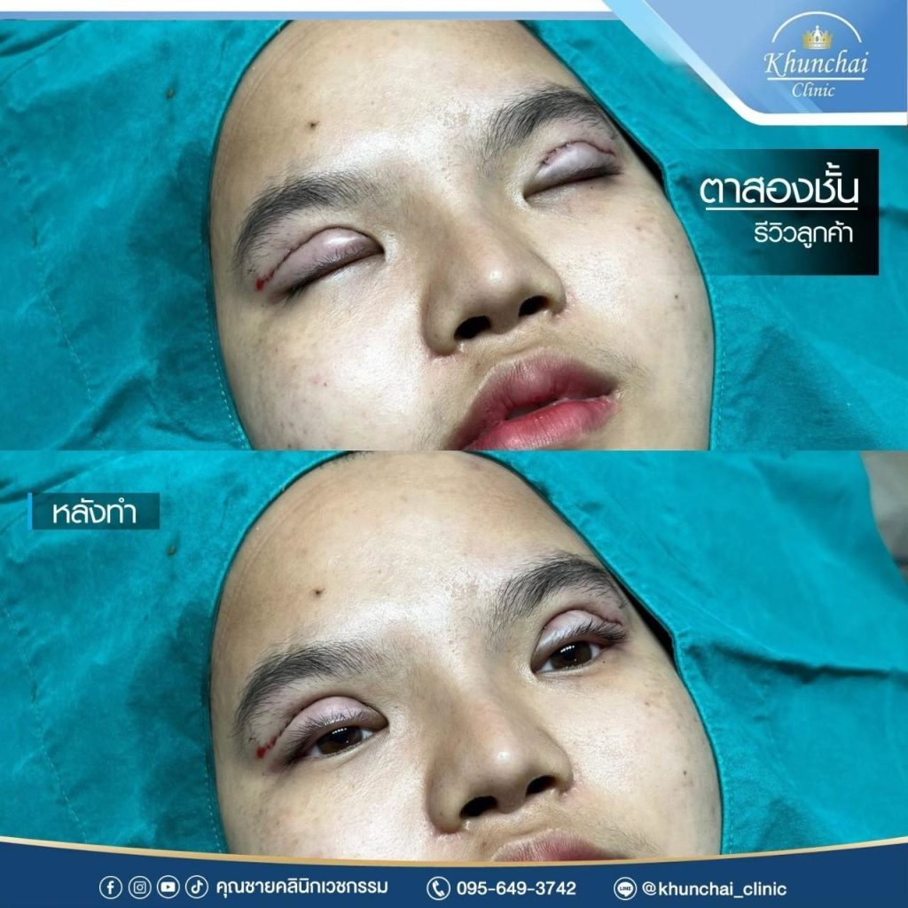 ตาสองชั้น