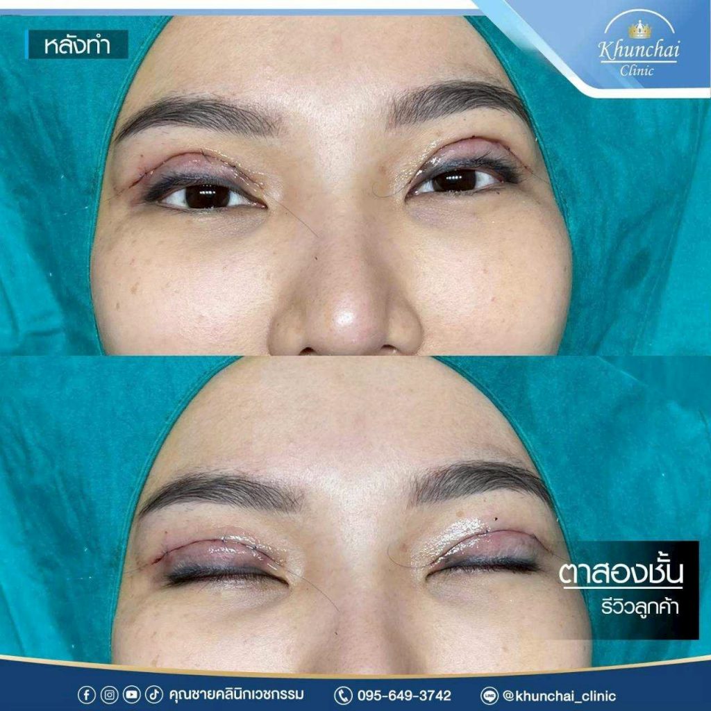 ตาสองชั้น