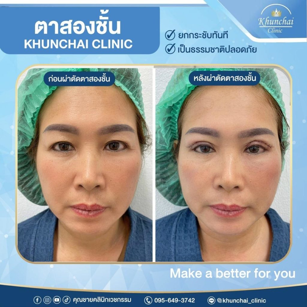 ตาสองชั้น